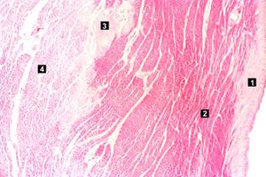 IPLab1MyocardialInfarction3.jpg