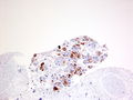 CytologicallyYoursCoW20140213Biopsy2.jpg.JPG