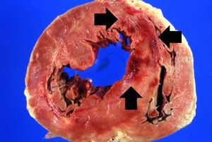 IPLab1MyocardialInfarction1.jpg