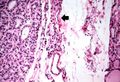 IPLab7Adenoma4.jpg