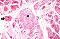 IPLab6SenileAmyloidosis4.jpg