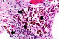 IPLab12Mesothelioma9.jpg