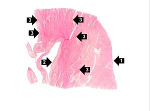 IPLab1MyocardialInfarction2.jpg