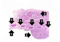 IPLab7Bronchogenic2.jpg