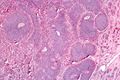 IPLab7Carcinoid3.jpg